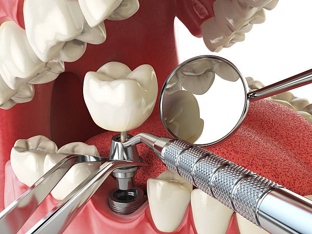 Best Emergency Cosmetic Dentistry (e.g., broken veneers) in Alexandria, LA